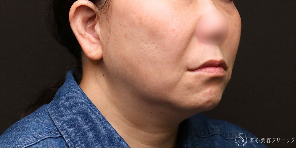 【50代女性・フェイスラインをすっきり】フェイスリフト＋脂肪吸引（頬＋顎下）＋リガメント処理（3ヶ月後） Before 