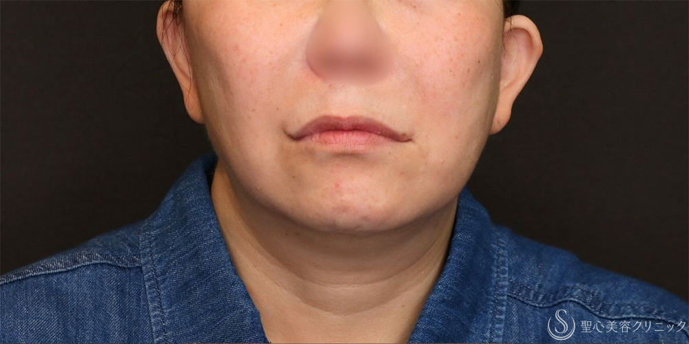 【50代女性・フェイスラインをすっきり】フェイスリフト＋脂肪吸引（頬＋顎下）＋リガメント処理（3ヶ月後） Before 