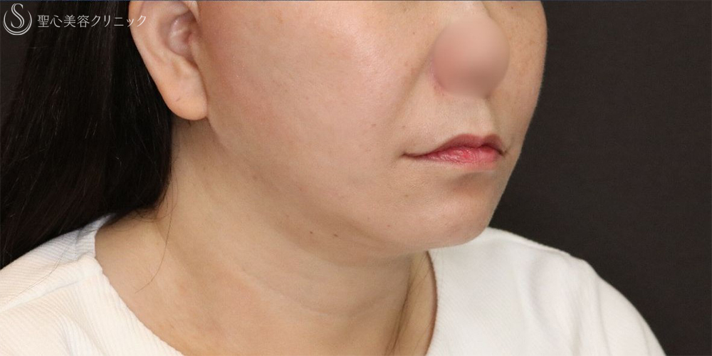 【50代女性・フェイスラインをすっきり】フェイスリフト＋脂肪吸引（頬＋顎下）＋リガメント処理（3ヶ月後） After 