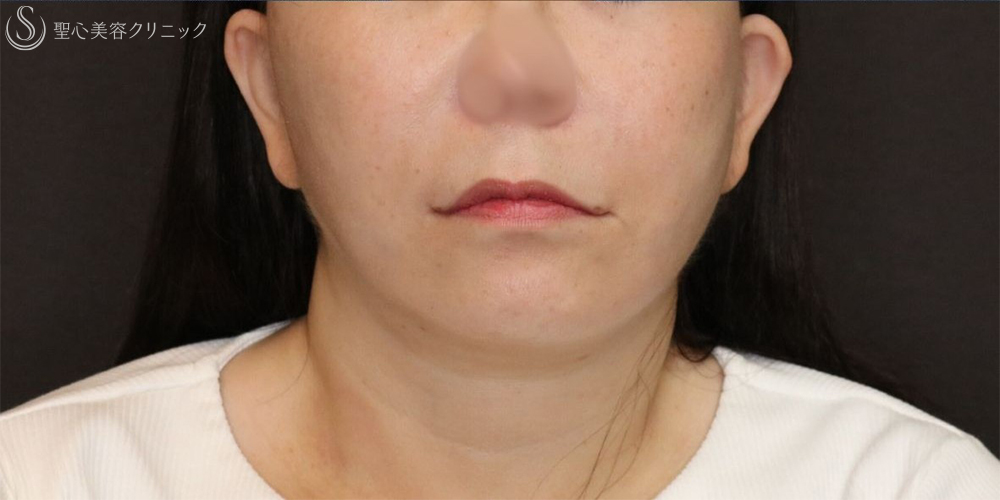 【50代女性・フェイスラインをすっきり】フェイスリフト＋脂肪吸引（頬＋顎下）＋リガメント処理（3ヶ月後） After 