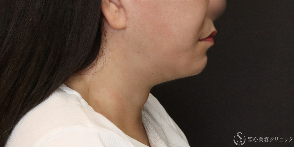 【50代女性・フェイスラインをすっきり】フェイスリフト＋脂肪吸引（頬＋顎下）＋リガメント処理（3ヶ月後） After 