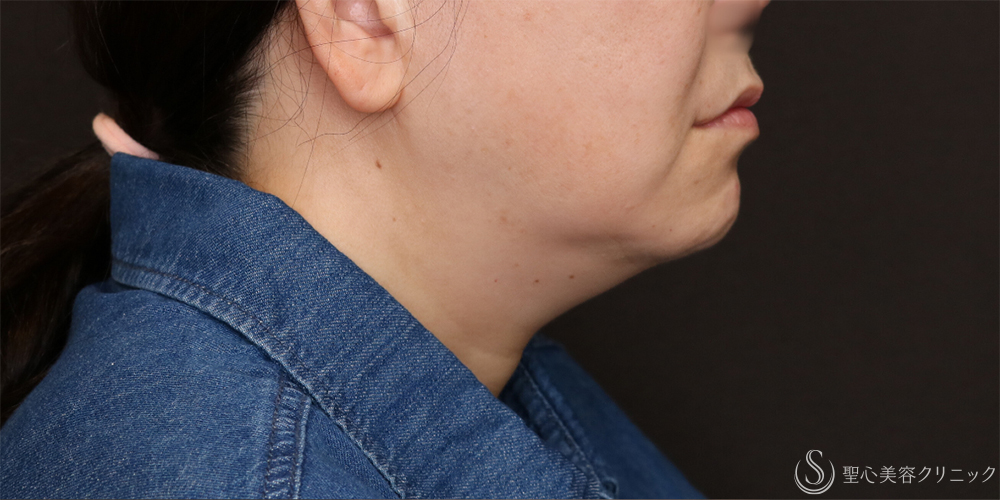 【50代女性・フェイスラインをすっきり】フェイスリフト＋脂肪吸引（頬＋顎下）＋リガメント処理（3ヶ月後） Before 