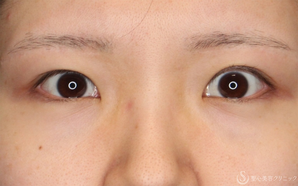 【20代女性・蒙古ひだのつっぱりを改善】目上切開（1ヶ月後） Before 