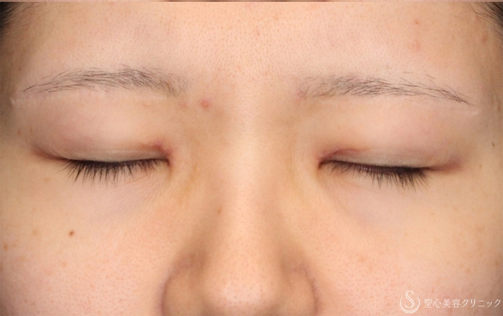 【20代女性・蒙古ひだのつっぱりを改善】目上切開（1ヶ月後） After 