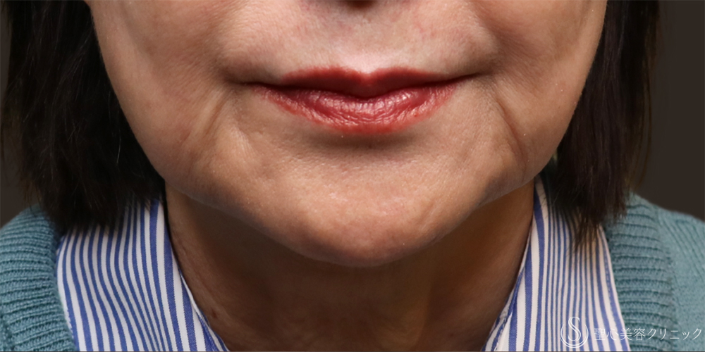【60代女性・口元の自然な若返り】プレミアムPRP皮膚再生療法（マリオネットライン）（6ヶ月後） Before 