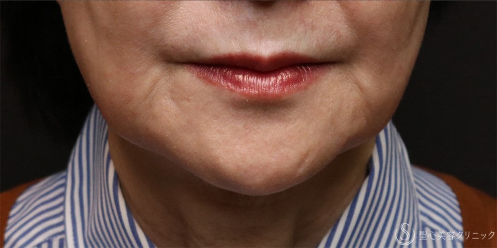 【60代女性・口元の自然な若返り】プレミアムPRP皮膚再生療法（マリオネットライン）（6ヶ月後） After 