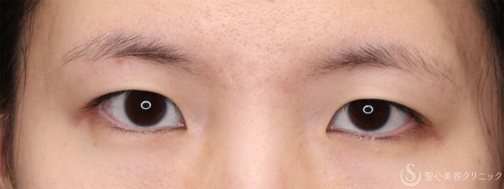 【20代女性・蒙古襞を減らす】目頭切開＋二重切開（術後1ヶ月～3ヶ月） Before 