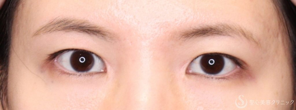 【20代女性・蒙古襞を減らす】目頭切開＋二重切開（術後1ヶ月～3ヶ月） After 