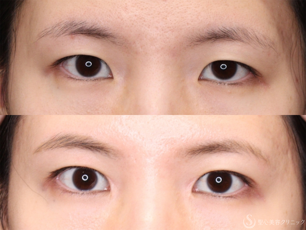 【20代女性・蒙古襞を減らす】目頭切開＋二重切開（術後1ヶ月～3ヶ月） After 