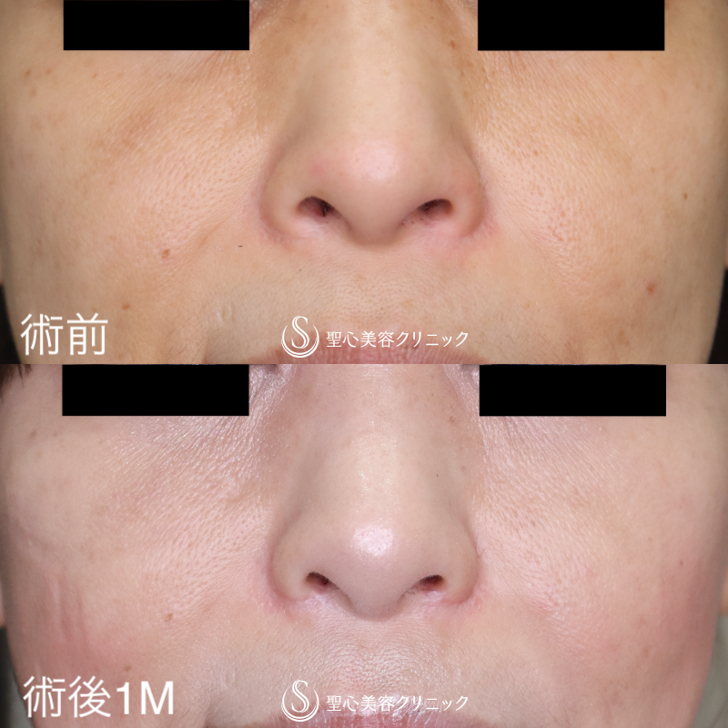 【40代女性・小鼻手術の他院修正】小鼻縮小術（術後1ヶ月） After 
