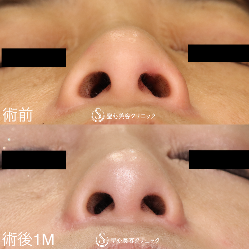 【40代女性・小鼻手術の他院修正】小鼻縮小術（術後1ヶ月） After 