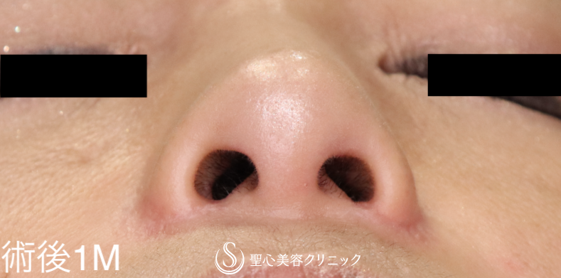 【40代女性・小鼻手術の他院修正】小鼻縮小術（術後1ヶ月） After 