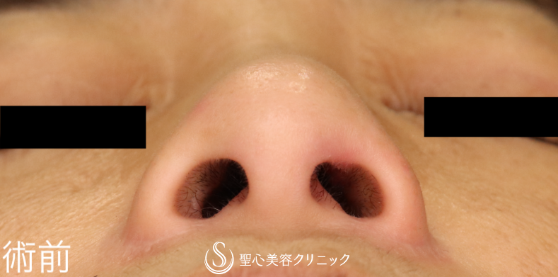 【40代女性・小鼻手術の他院修正】小鼻縮小術（術後1ヶ月） Before 