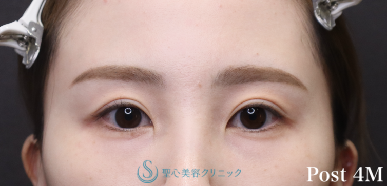 【20代女性・目の下のクマを注入のみで改善】プレミアムPRP皮膚再生療法（術後4ヶ月） After 
