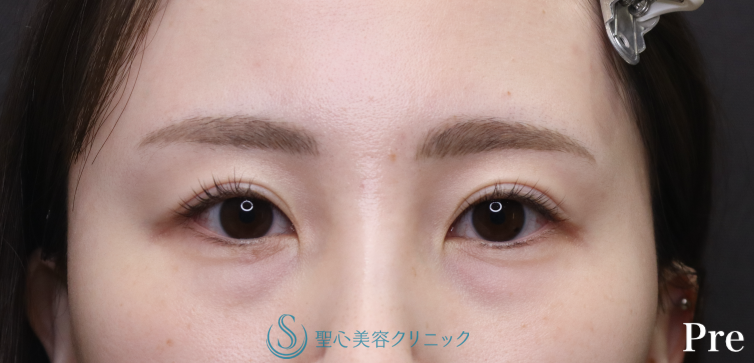 【20代女性・目の下のクマを注入のみで改善】プレミアムPRP皮膚再生療法（術後4ヶ月） Before 