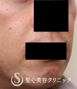 【40代男性・ほうれい線治療の長期経過】プレミアムPRP皮膚再生療法（術後1年4ヶ月） After 