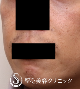 【40代男性・ほうれい線治療の長期経過】プレミアムPRP皮膚再生療法（術後1年4ヶ月） After 