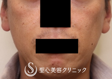 【40代男性・ほうれい線治療の長期経過】プレミアムPRP皮膚再生療法（術後1年4ヶ月） After 