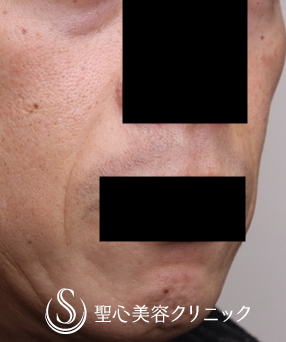 【40代男性・ほうれい線治療の長期経過】プレミアムPRP皮膚再生療法（術後1年4ヶ月） Before 