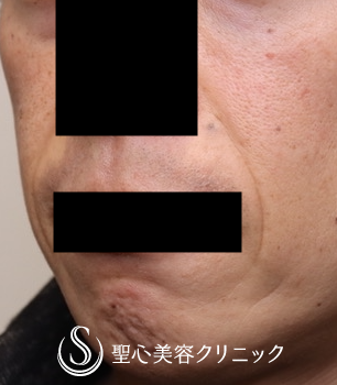 【40代男性・ほうれい線治療の長期経過】プレミアムPRP皮膚再生療法（術後1年4ヶ月） Before 