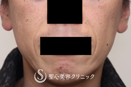 【40代男性・ほうれい線治療の長期経過】プレミアムPRP皮膚再生療法（術後1年4ヶ月） Before 