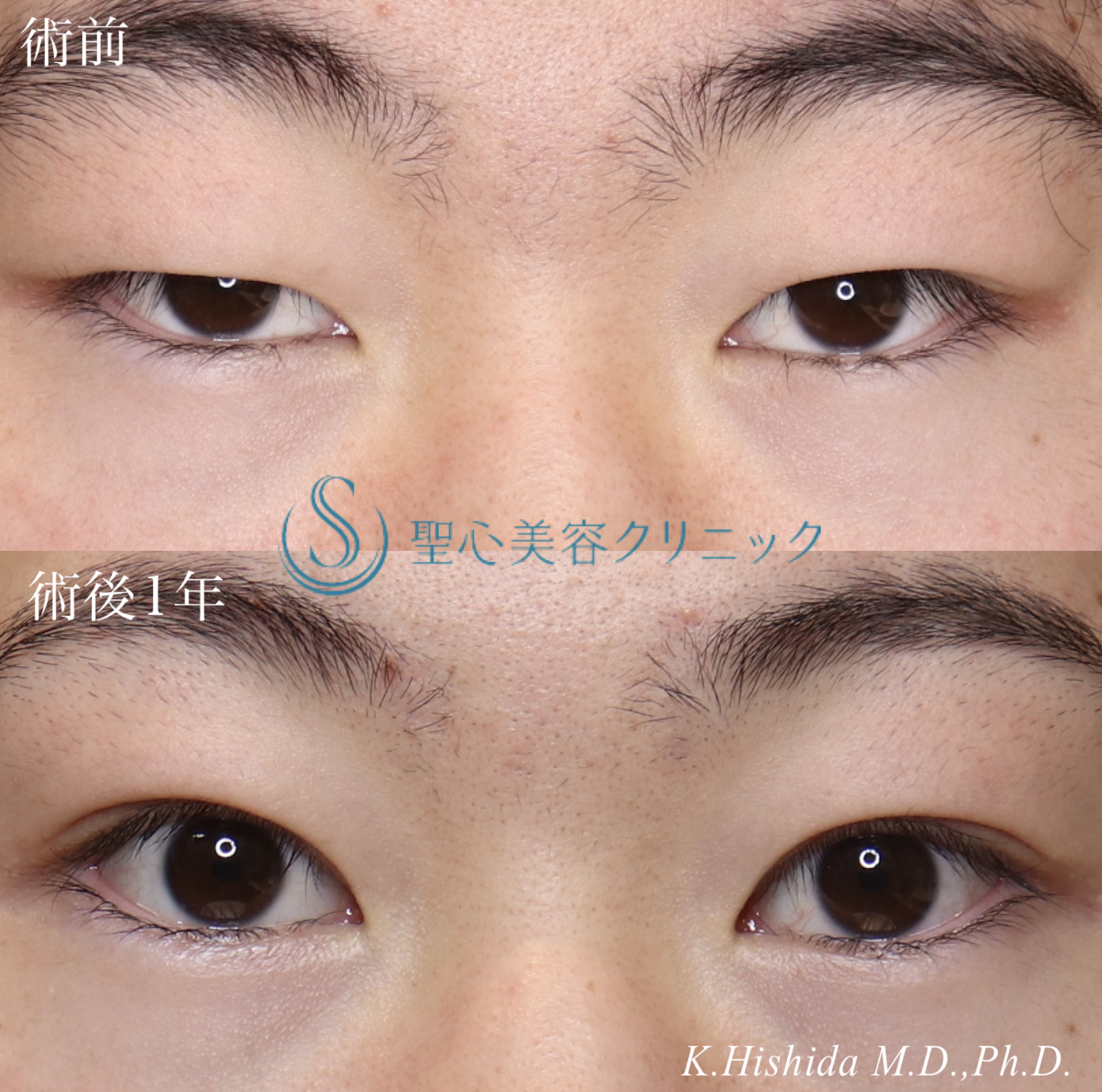 【20代男性・目を大きくパッチリに！！】眼瞼下垂（切開法/腱膜縫縮法）＋脱脂（術後1年～1年2ヶ月） After 