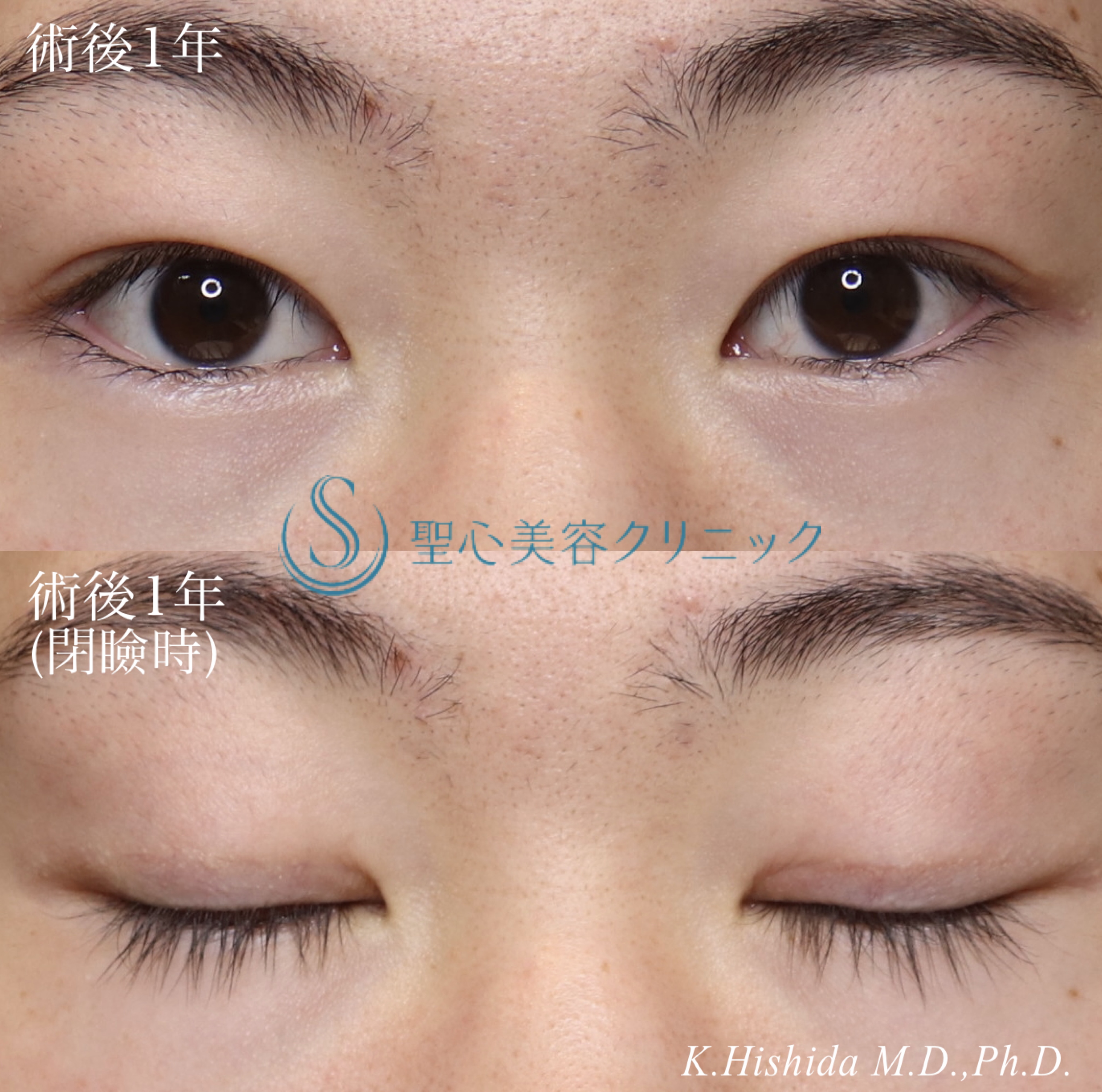 【20代男性・目を大きくパッチリに！！】眼瞼下垂（切開法/腱膜縫縮法）＋脱脂（術後1年～1年2ヶ月） After 