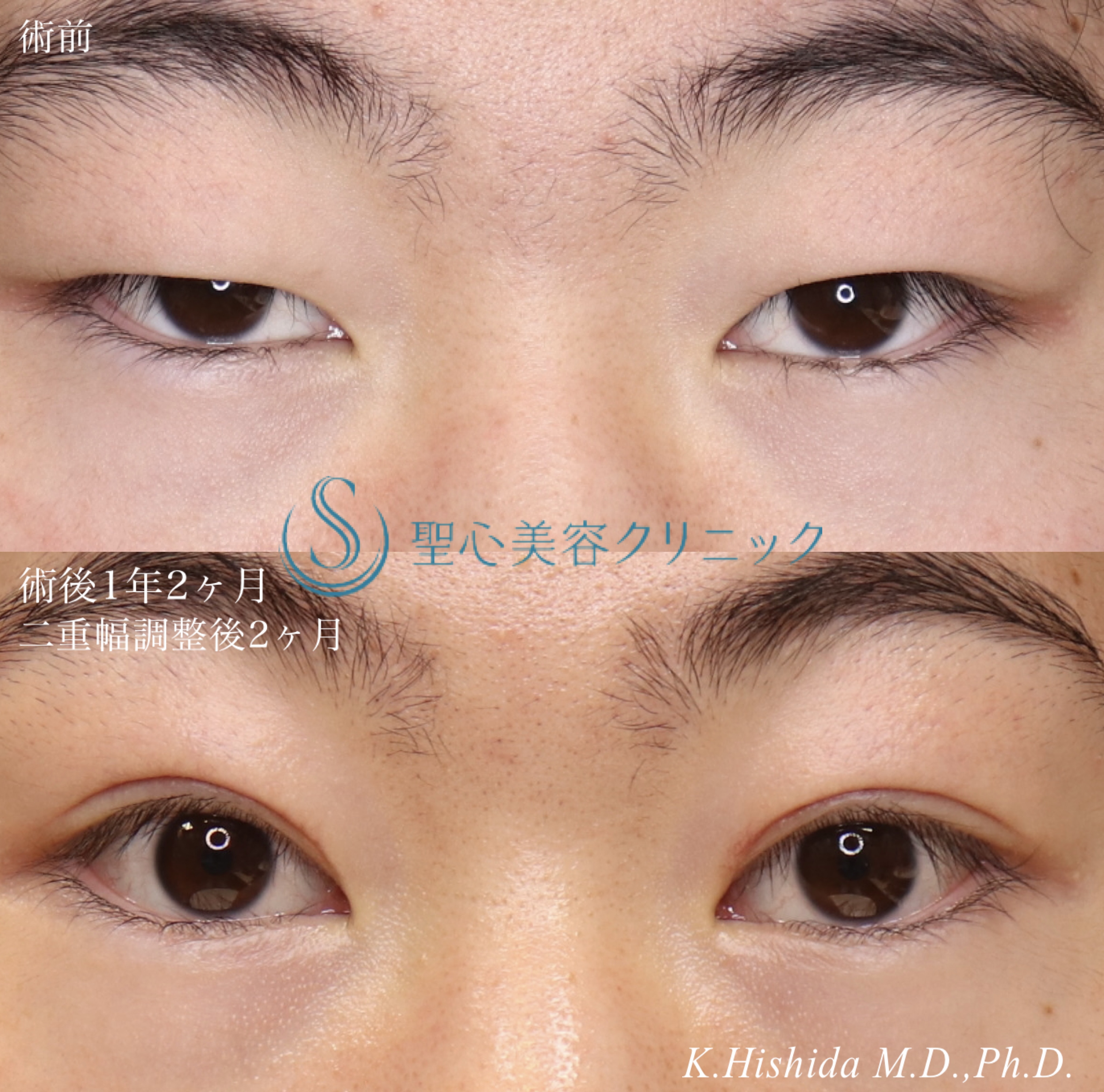 【20代男性・目を大きくパッチリに！！】眼瞼下垂（切開法/腱膜縫縮法）＋脱脂（術後1年～1年2ヶ月） After 