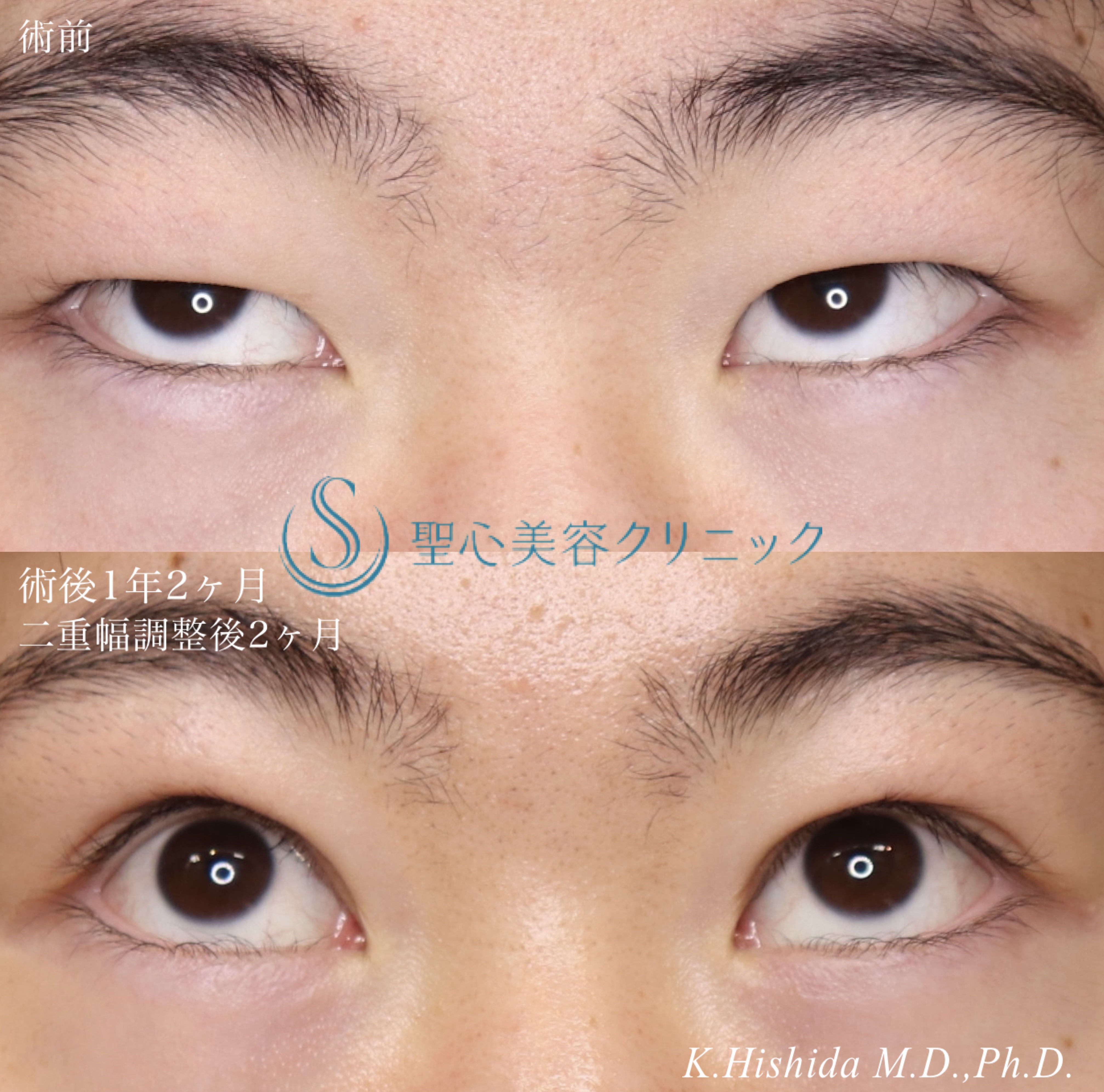 【20代男性・目を大きくパッチリに！！】眼瞼下垂（切開法/腱膜縫縮法）＋脱脂（術後1年～1年2ヶ月） After 