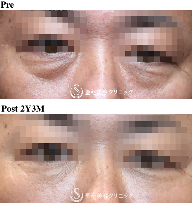 【50代男性・目の下のクマを注入のみで改善】プレミアムPRP皮膚再生療法（術後2年3ヶ月） After 