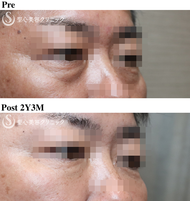 【50代男性・目の下のクマを注入のみで改善】プレミアムPRP皮膚再生療法（術後2年3ヶ月） After 