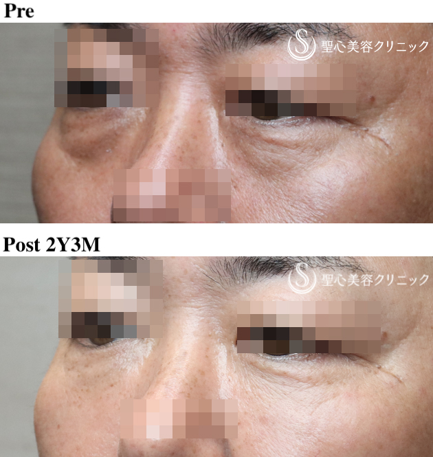 【50代男性・目の下のクマを注入のみで改善】プレミアムPRP皮膚再生療法（術後2年3ヶ月） After 