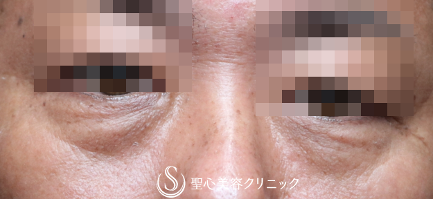【50代男性・目の下のクマを注入のみで改善】プレミアムPRP皮膚再生療法（術後2年3ヶ月） Before 