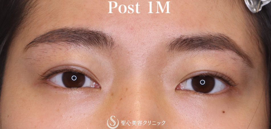 【20代女性・はっきりした二重に】二重術（埋没法）：マイクロメソッド+α（術後1ヶ月） After 