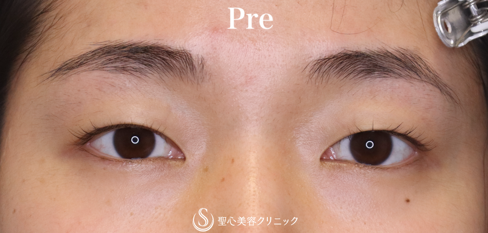 【20代女性・はっきりした二重に】二重術（埋没法）：マイクロメソッド+α（術後1ヶ月） Before 