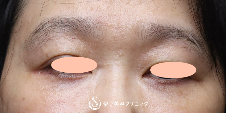 【50代女性・目の下のたるみの左右差を調整】下眼瞼切開術/下眼瞼除皺術/ハムラ法（右のみ）（術後1ヶ月） After 