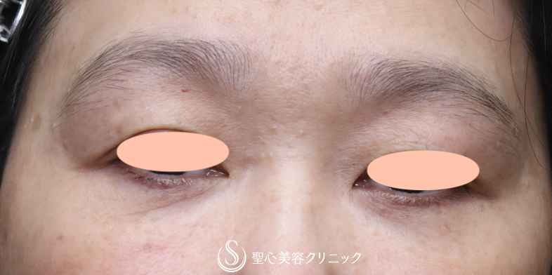 【50代女性・目の下のたるみの左右差を調整】下眼瞼切開術/下眼瞼除皺術/ハムラ法（右のみ）（術後1ヶ月） Before 