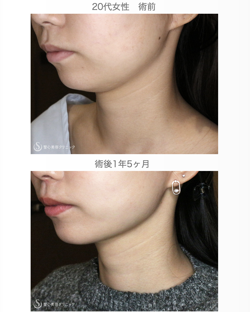 【20台女性・抜群の小顔効果】脂肪吸引注射「あご下」（術直後〜1年5ヶ月後） After 