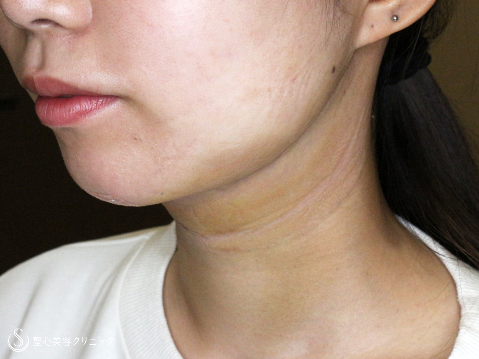 【20台女性・抜群の小顔効果】脂肪吸引注射「あご下」（術直後〜1年5ヶ月後） After 