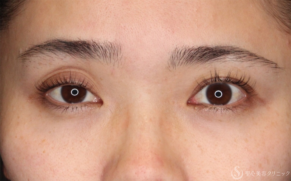 【30代女性・右まぶたの開き改善】眼瞼下垂（埋没法）（右のみ）（1ヶ月後） Before 