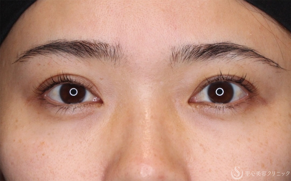 【30代女性・右まぶたの開き改善】眼瞼下垂（埋没法）（右のみ）（1ヶ月後） After 