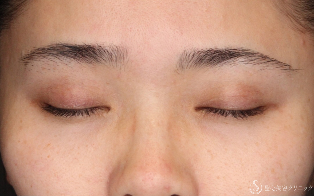 【30代女性・右まぶたの開き改善】眼瞼下垂（埋没法）（右のみ）（1ヶ月後） Before 