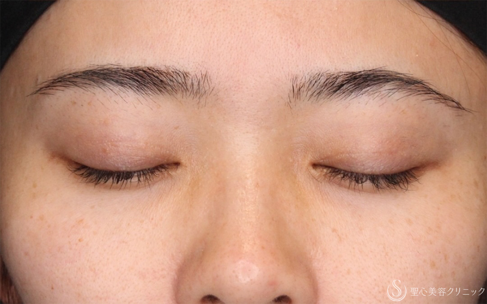 【30代女性・右まぶたの開き改善】眼瞼下垂（埋没法）（右のみ）（1ヶ月後） After 