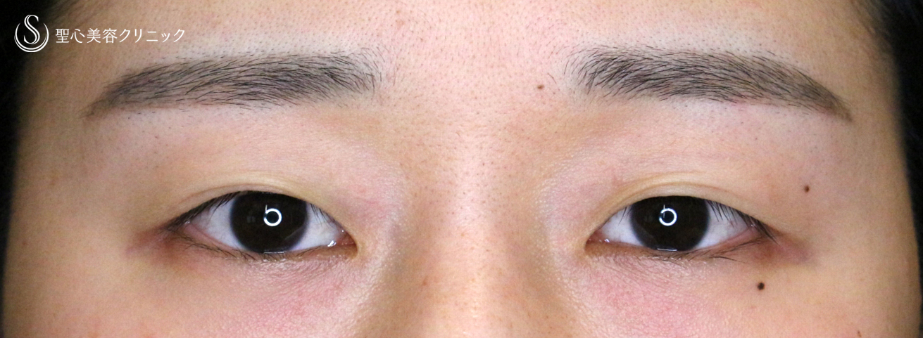 【20代女性・理想のMix型二重をつくる】二重全切開+α法「Ver.5.5」単独（術直後〜4ヶ月後） Before 