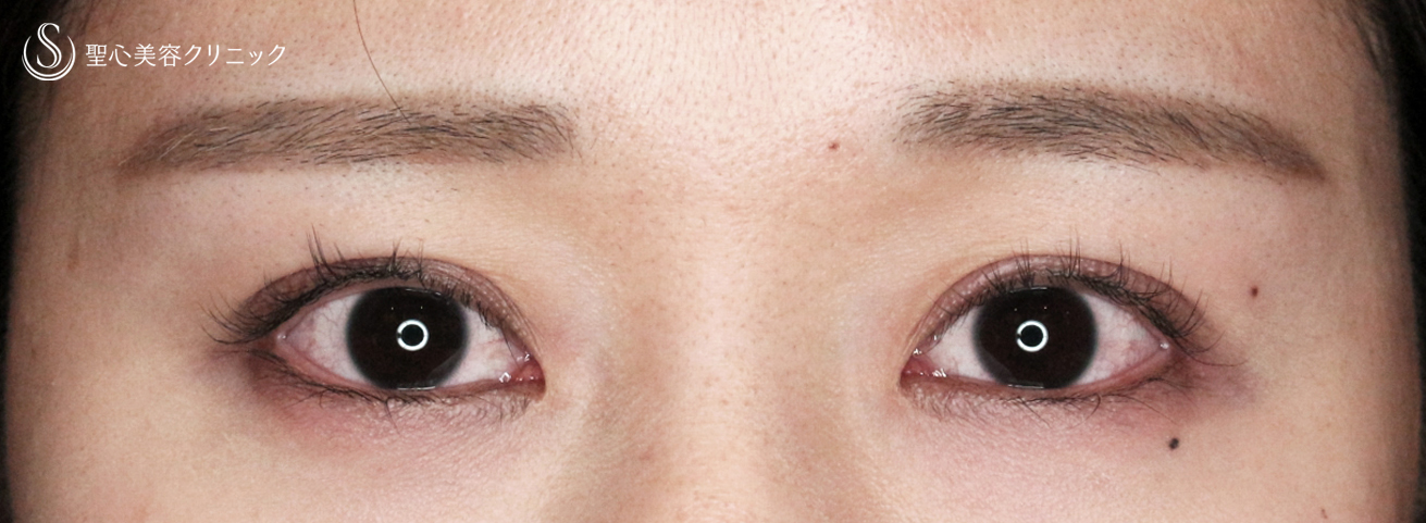 【20代女性・理想のMix型二重をつくる】二重全切開+α法「Ver.5.5」単独（術直後〜4ヶ月後） After 