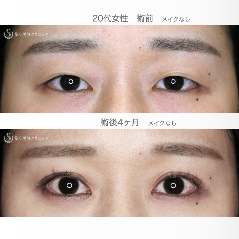 【20代女性・理想のMix型二重をつくる】二重全切開+α法「Ver.5.5」単独（術直後〜4ヶ月後） After 