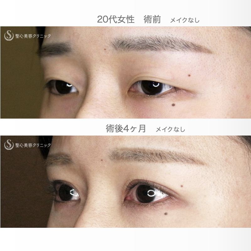 【20代女性・理想のMix型二重をつくる】二重全切開+α法「Ver.5.5」単独（術直後〜4ヶ月後） After 