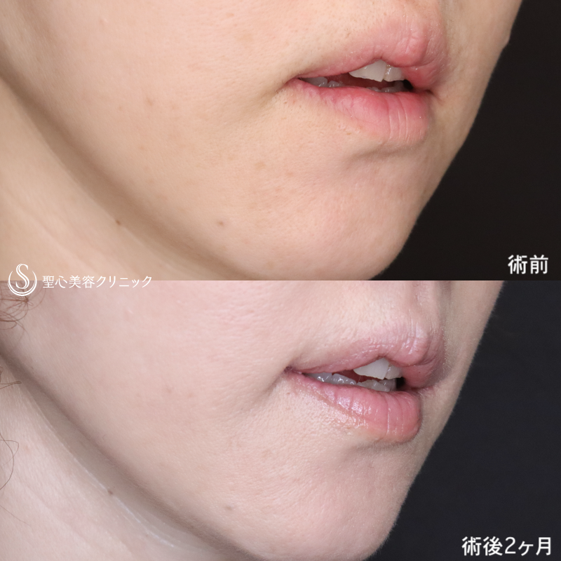 【50代女性・他院修正で上唇の形を整える】プレミアム口角挙上術（術直後～術後2ヶ月） After 