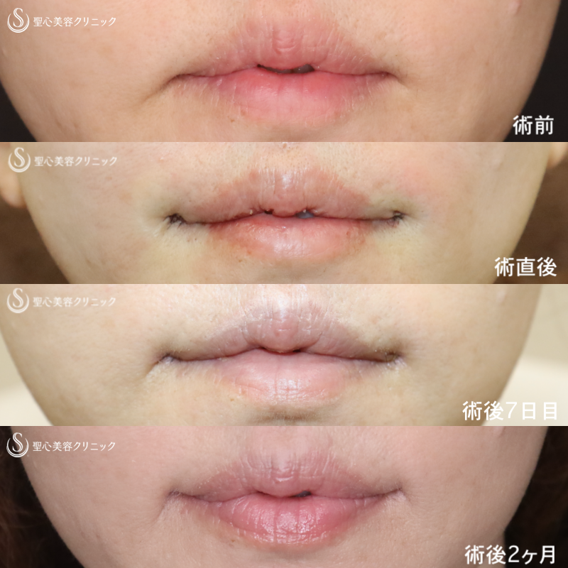【50代女性・他院修正で上唇の形を整える】プレミアム口角挙上術（術直後～術後2ヶ月） After 