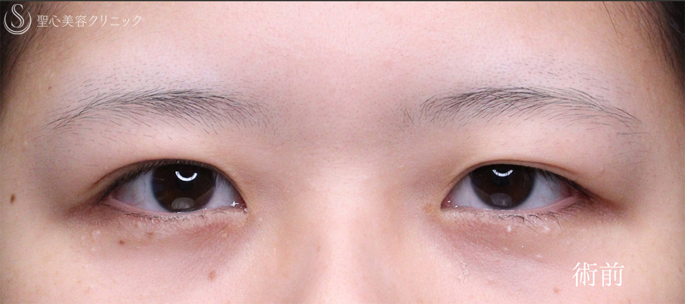 【20代女性・お目元をスッキリ可愛く仕上げます】二重術（切開法）部分切開/全切開（術後直後～1ヶ月） Before 